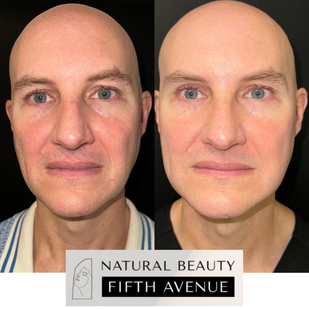 Before and after comparison of male patient's face showing reduced puffiness and improved skin texture